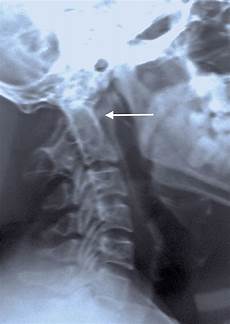 Normal Motor Axial Aspirator