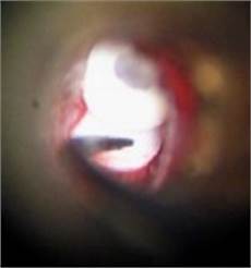 Ventilation Canal Insertion Clamp